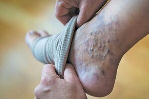 علایمی در پا که باید جدی بگیرید